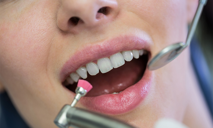 Teeth cleaning and polishing 
